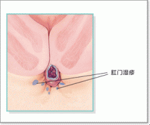 肛门湿疹示意图